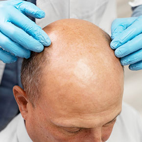 Exosomes Hair Growth Therapy